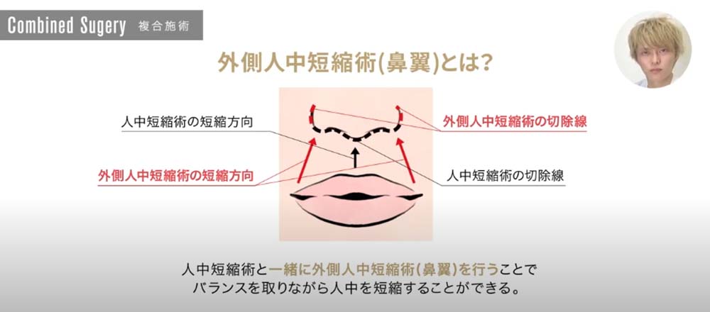 外側人中短縮術（鼻翼）とは？｜人中短縮術と一緒に外側人中短縮術（鼻翼）を行うことでバランスを取りながら人中を短縮することができる。