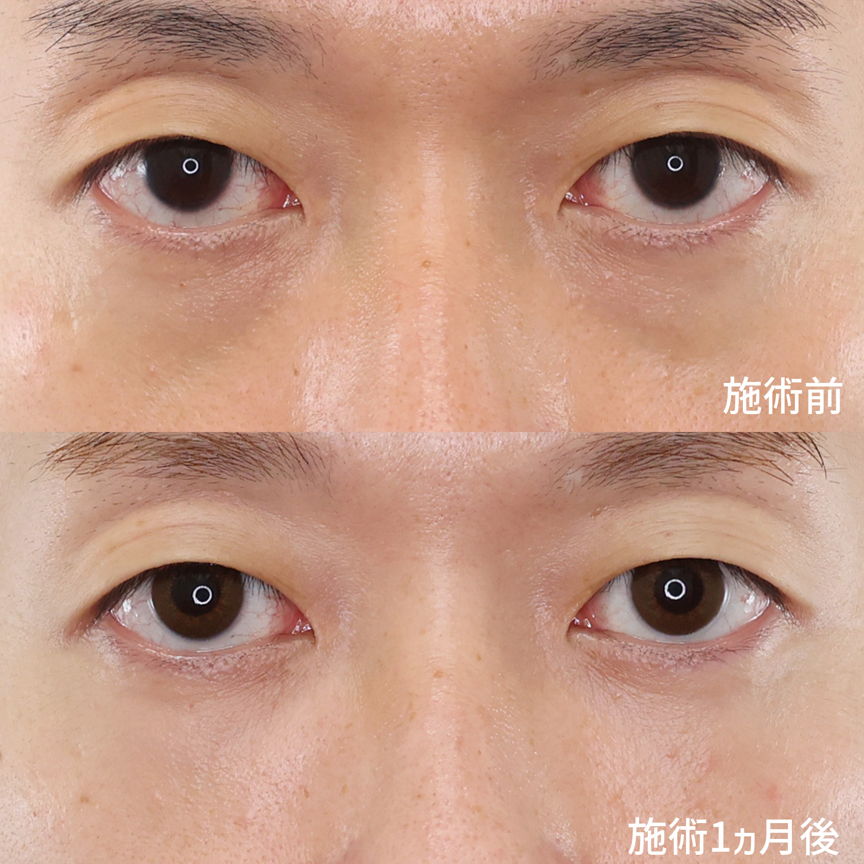 下眼瞼脱脂術（目の下のたるみ取り・目の下の脂肪ふくらみ取り）/顔の脂肪注入(コンデンスリッチフェイス)の症例写真 施術前後 