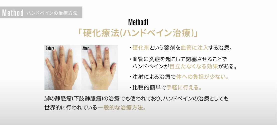 硬化療法について
