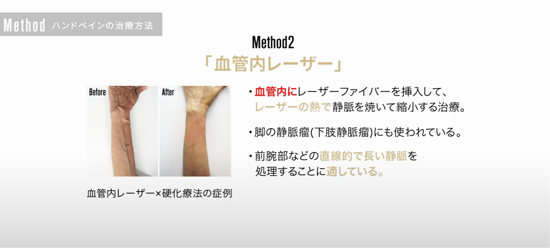 血管内レーザーについて