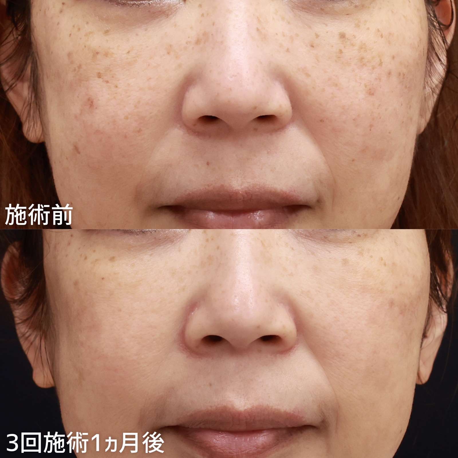 フォトシルクプラス光治療の症例写真 施術前後 