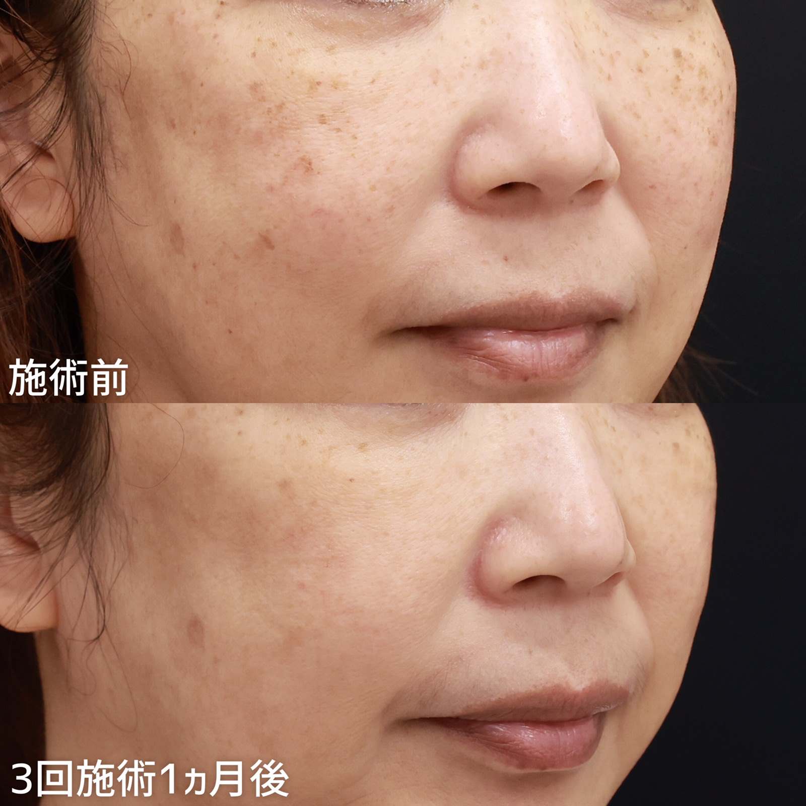 フォトシルクプラス光治療の症例写真 施術前後 