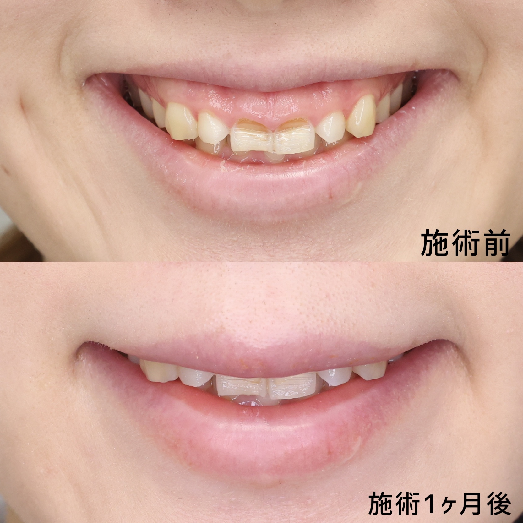 ガミースマイル切開法/ボトックス注射：その他の症例写真 施術前後 