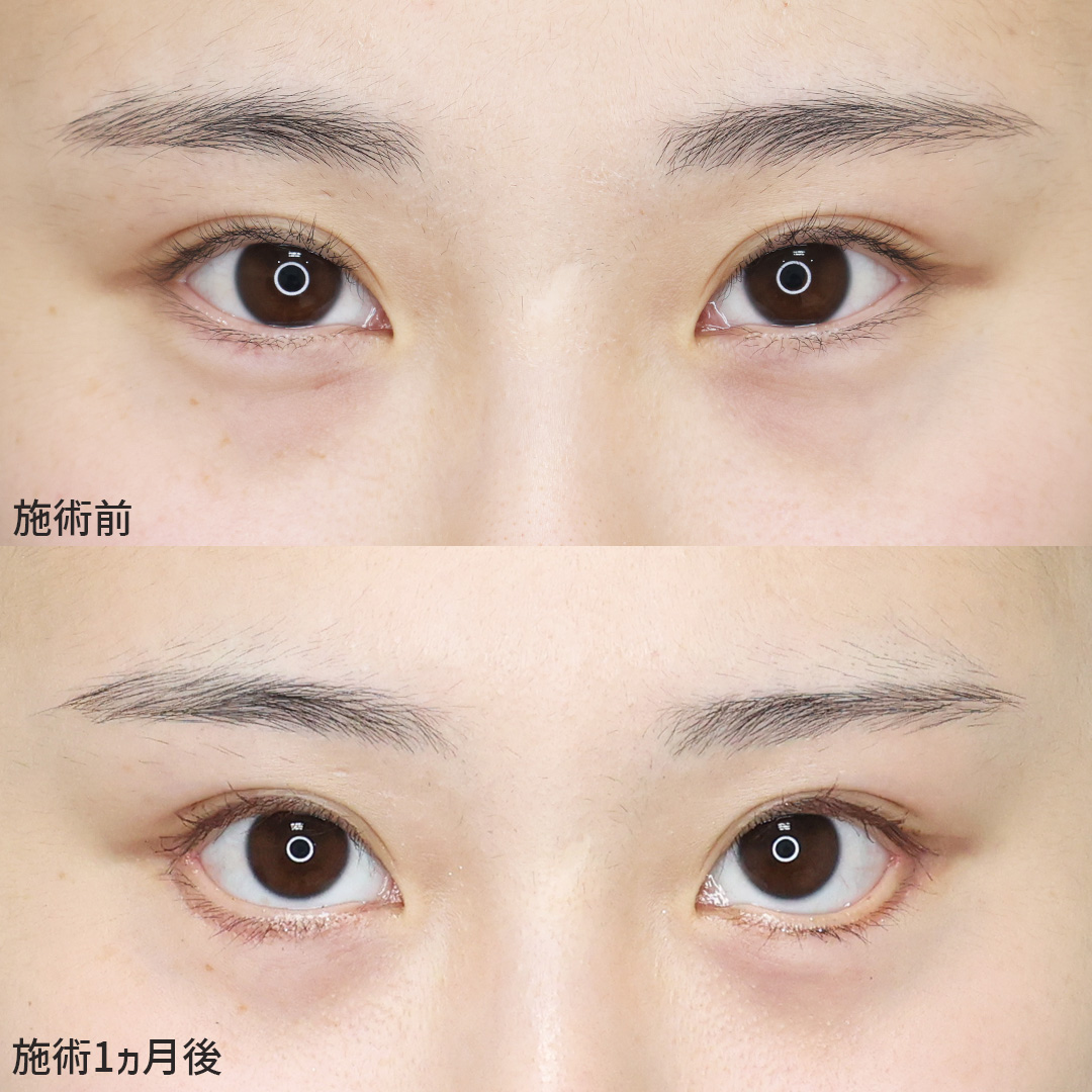 目尻切開術/グラマラスライン（タレ目形成）の症例写真 施術前後 1ヵ月
