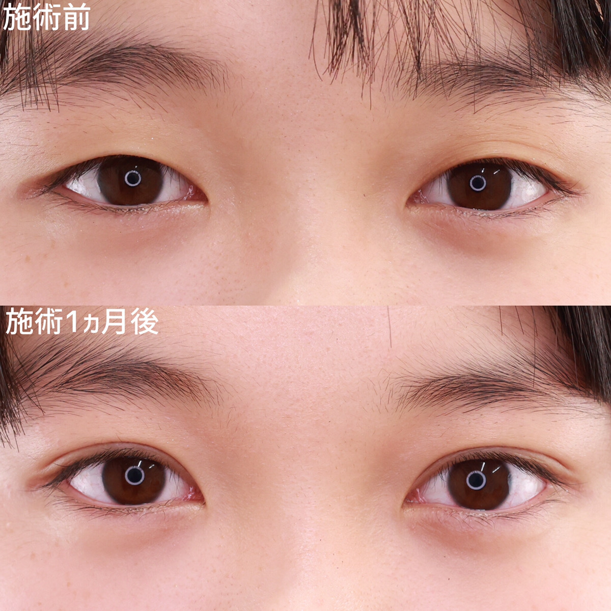 二重埋没法/目元：その他の症例写真 施術前後 