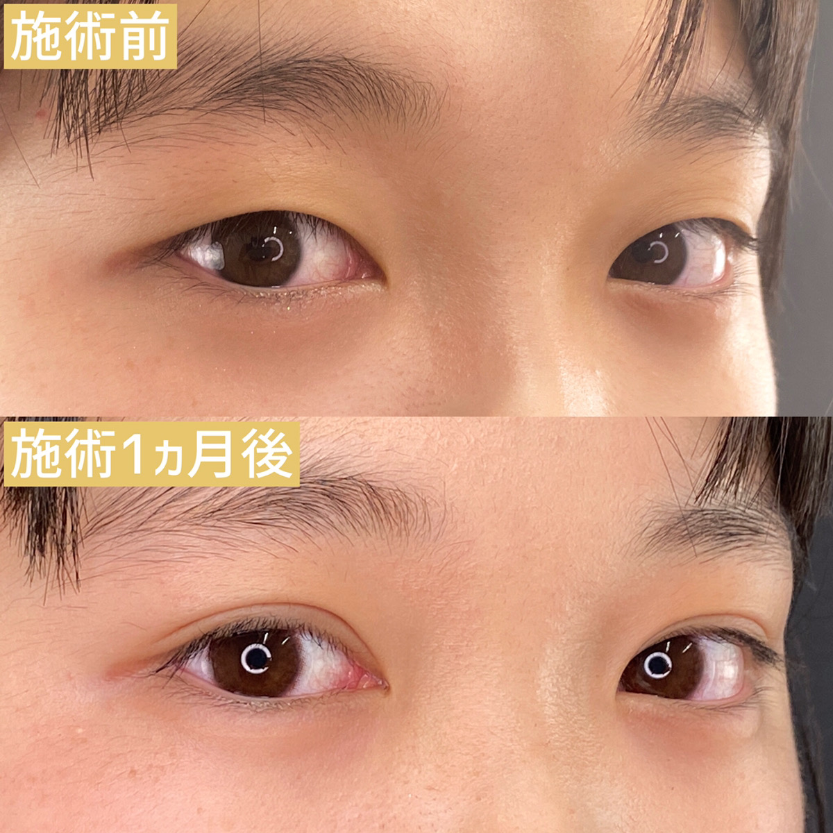 二重埋没法/目元：その他の症例写真 施術前後 