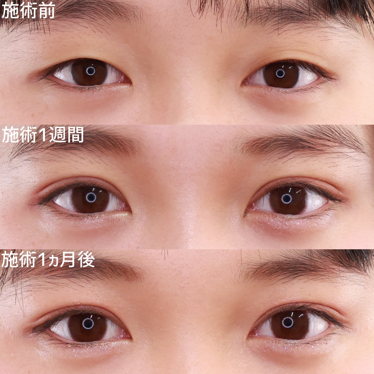 二重埋没法/目元：その他の症例写真 施術前後 
