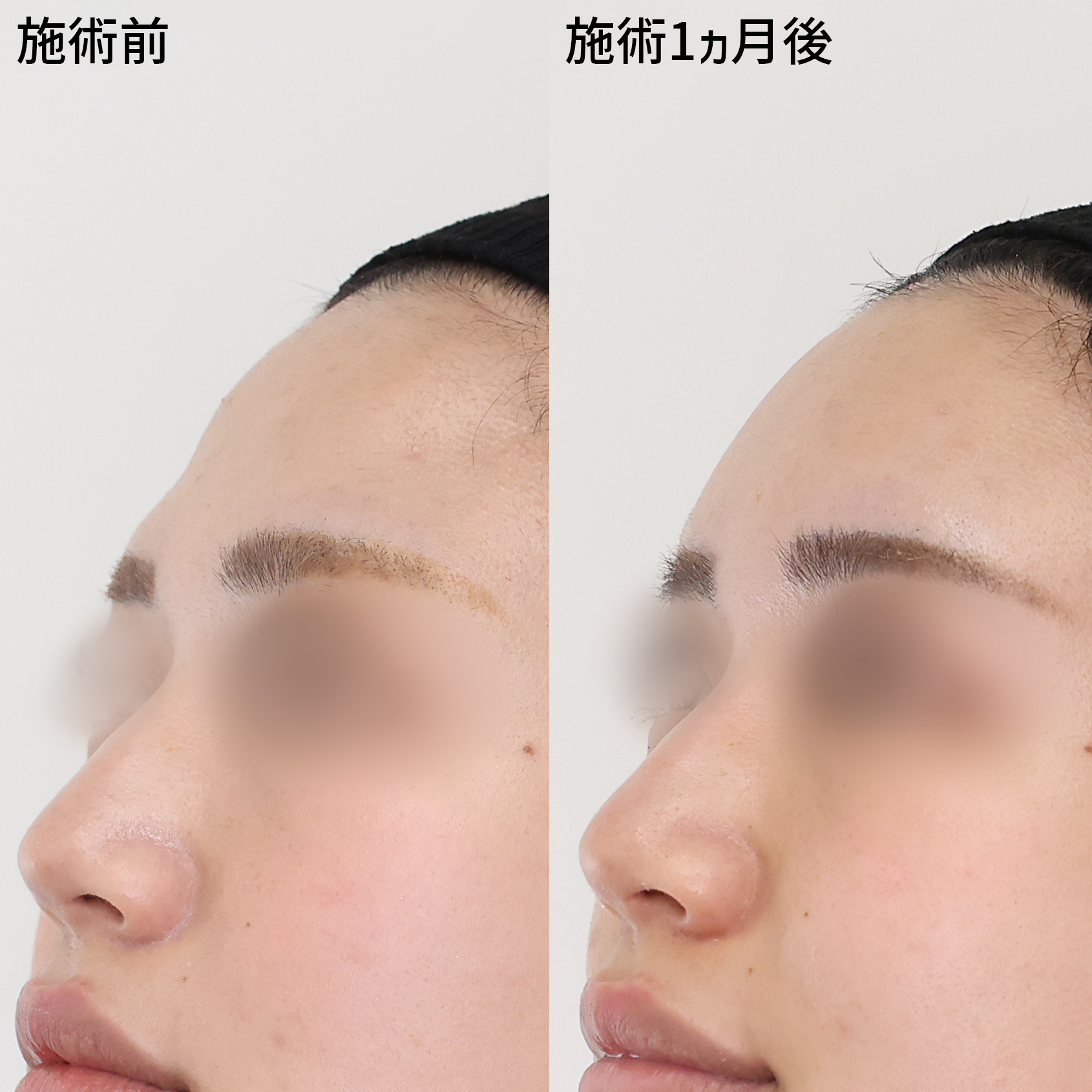 おでこの脂肪注入（オルチャンデコ形成）の症例写真 施術前後 １ヵ月