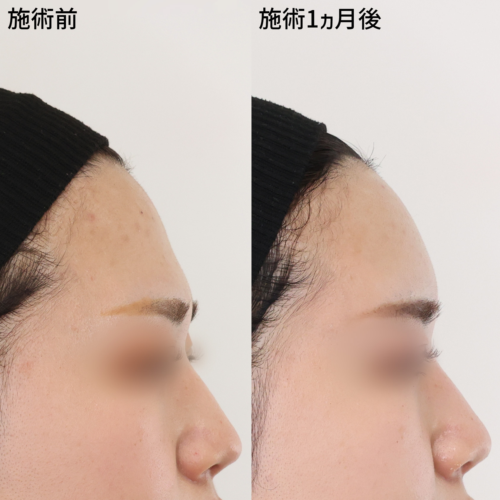 おでこの脂肪注入（オルチャンデコ形成）の症例写真 施術前後 １ヵ月