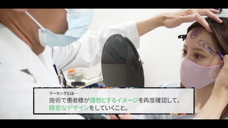マーキングとは…施術で患者様が理想とするイメージを再度確認して、精密なデザインをしていくこと。