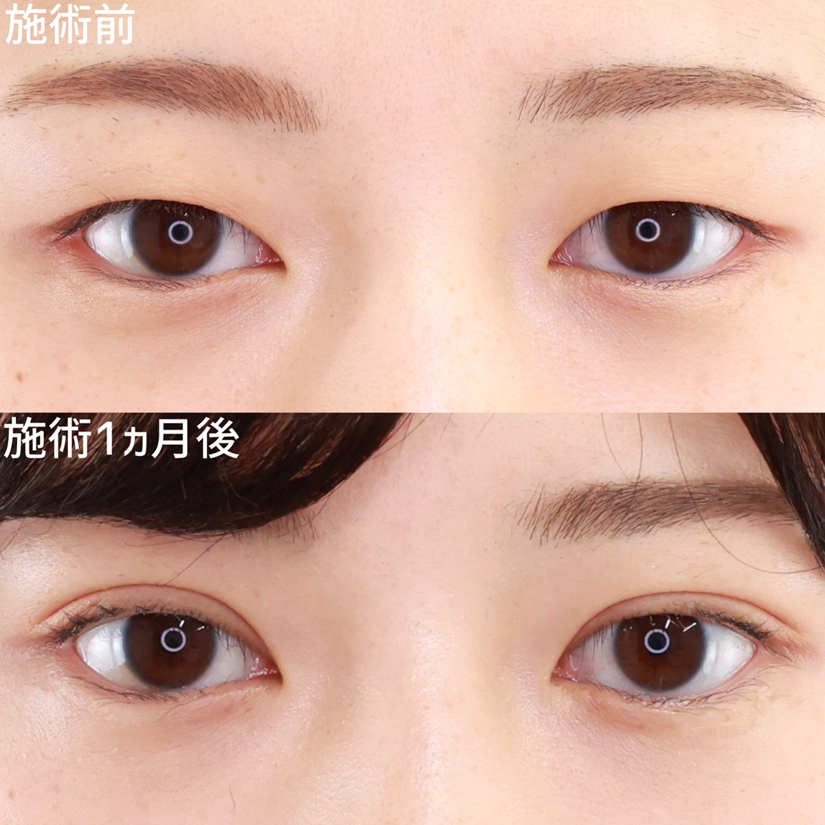 二重埋没法/目元：その他の症例写真 施術前後 