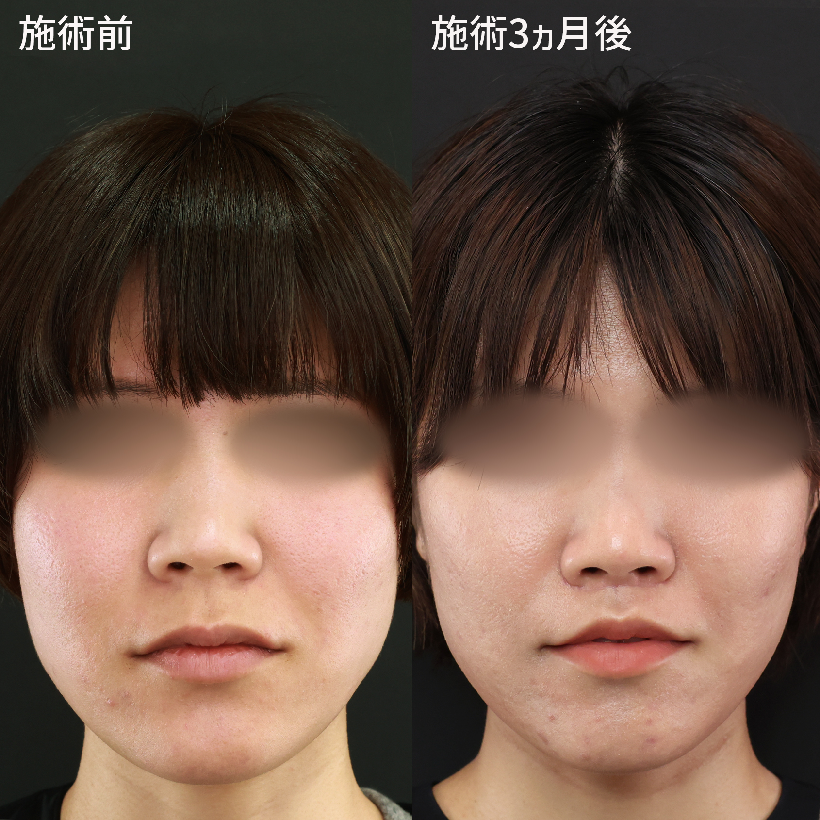 人中短縮術(リップリフト)・外側人中短縮術/はちみつ注射（WSC-PRP）の症例写真 施術前後 