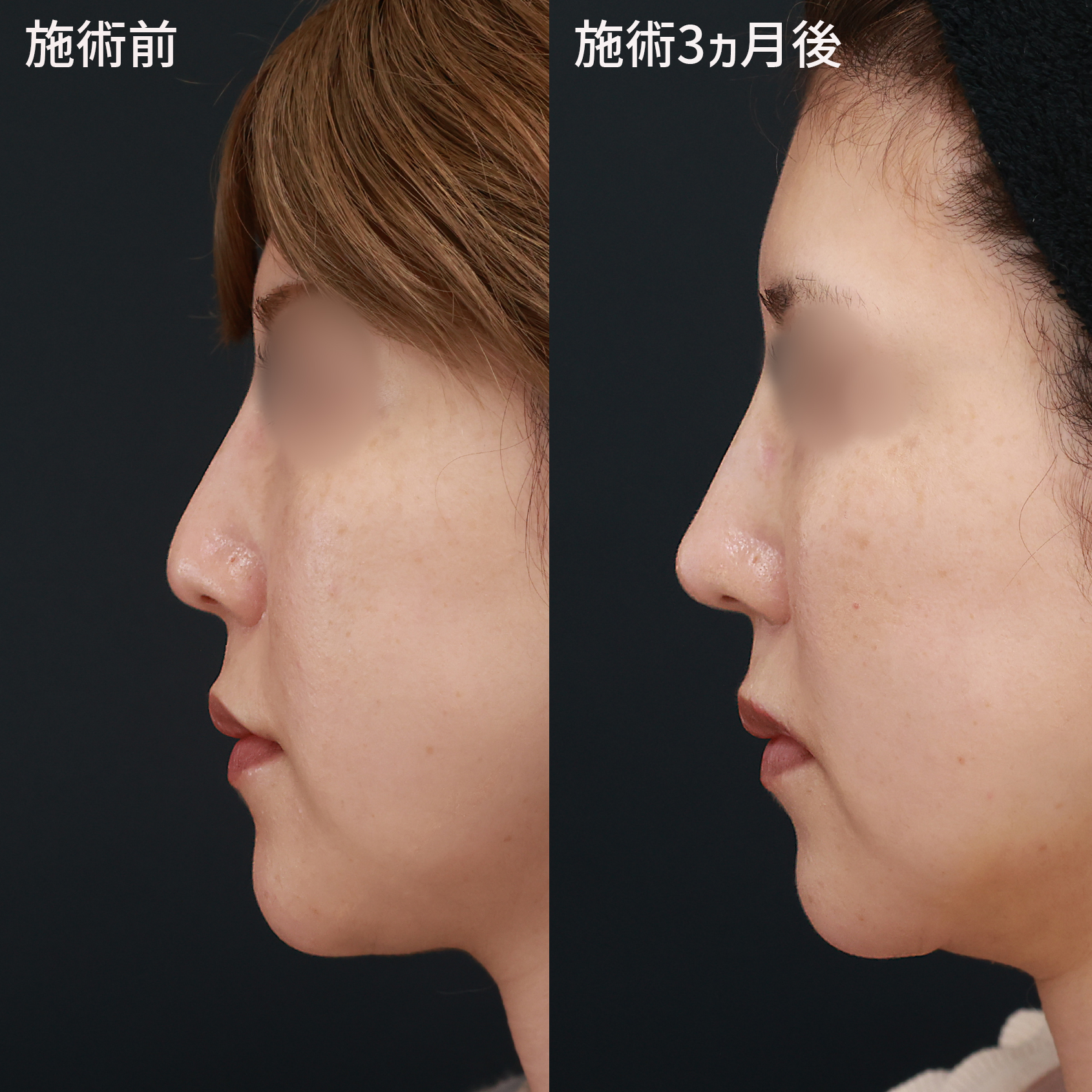鼻尖4Dノーズの症例写真 施術前後 