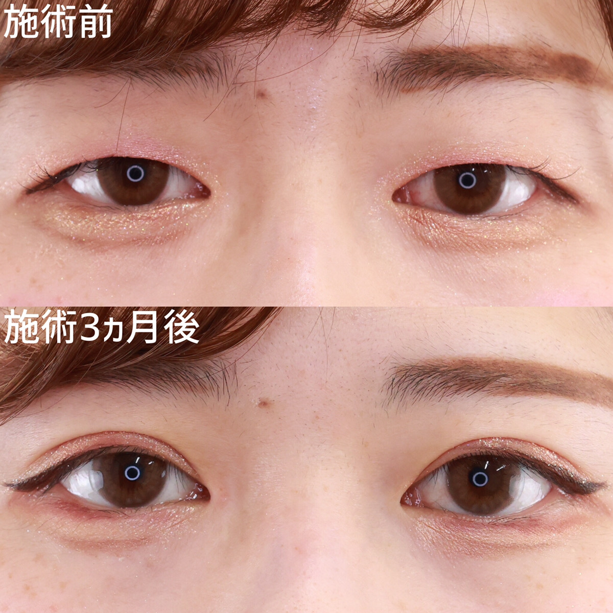 上眼瞼切開術の症例画像