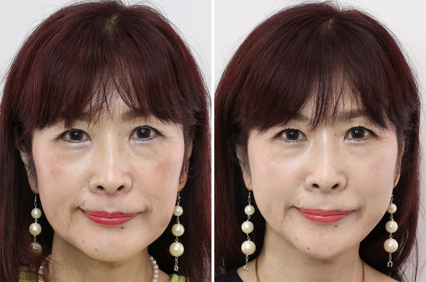 TAC式 ツヤ肌コラーゲンリフト®/エラボトックス注射の症例写真 施術前後 １ヵ月