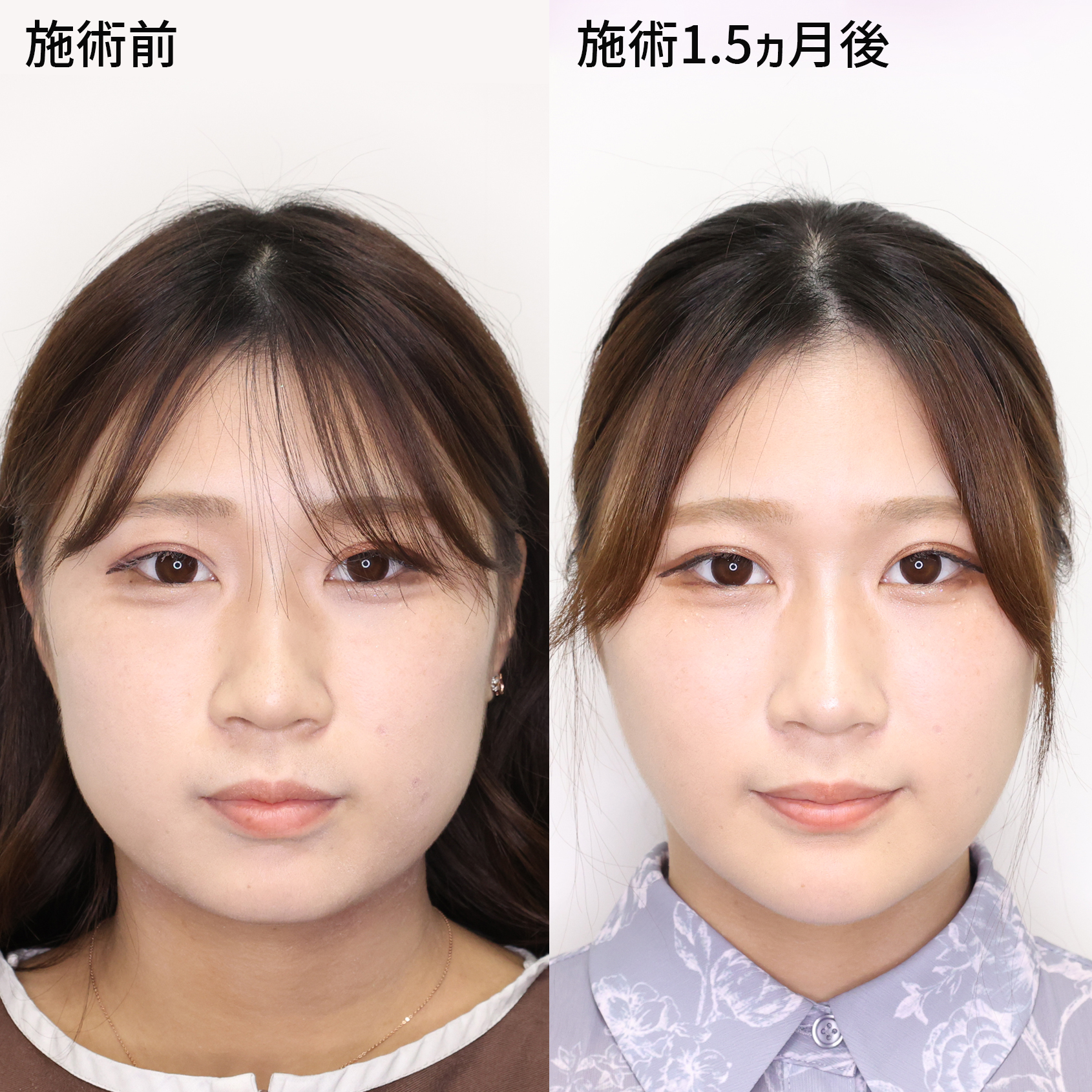 【小顔施術5点セット】別人級の小顔になりたい方はTAクリニック