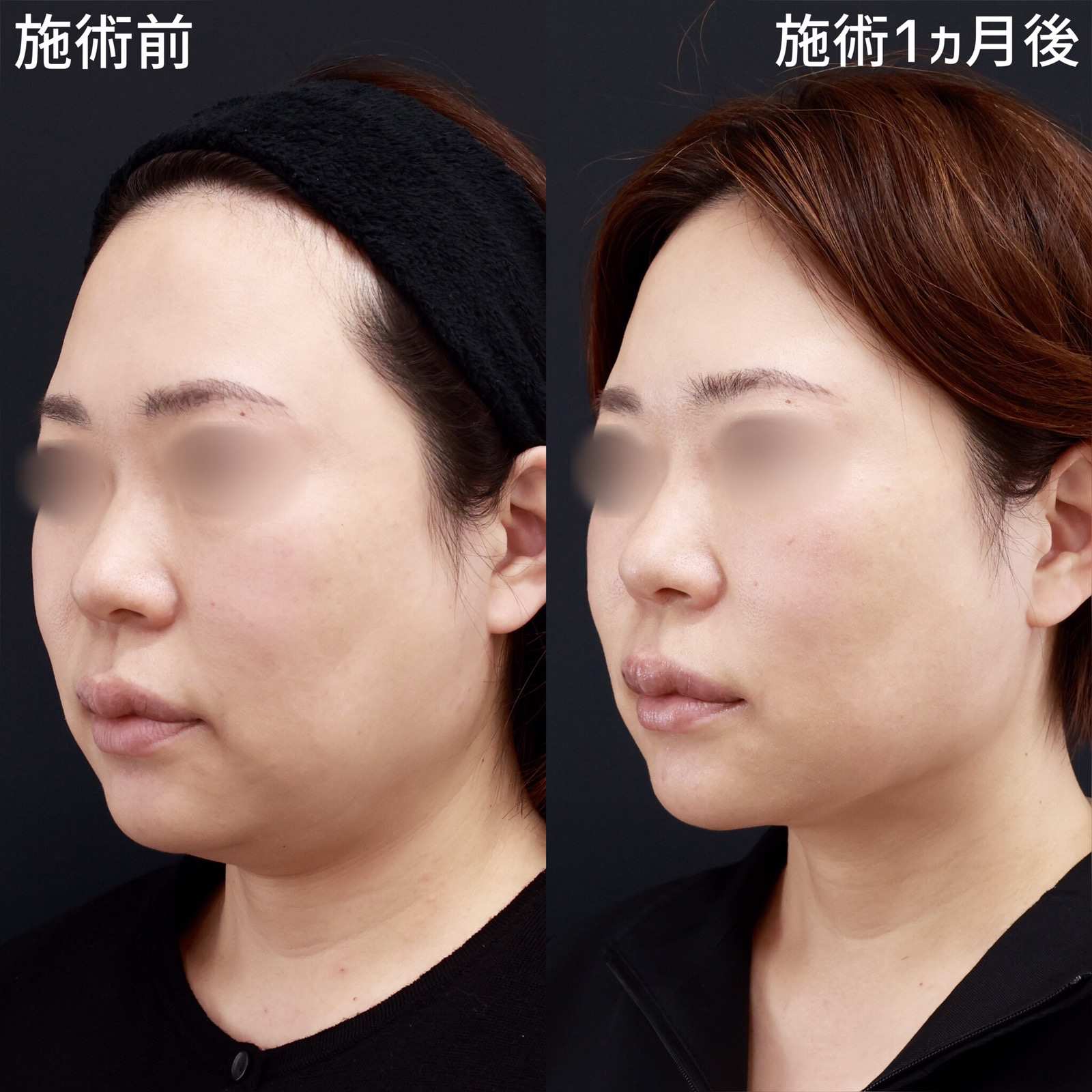 顎下の脂肪吸引の症例写真 施術前後 