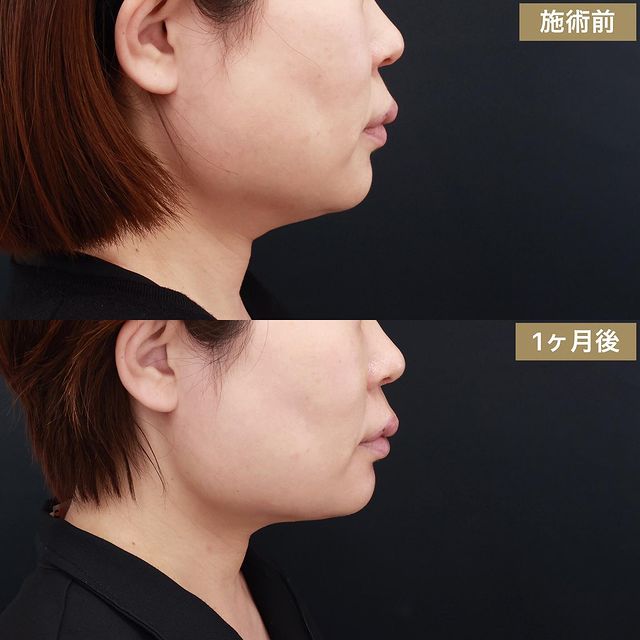顎下の脂肪吸引の症例写真 施術前後 