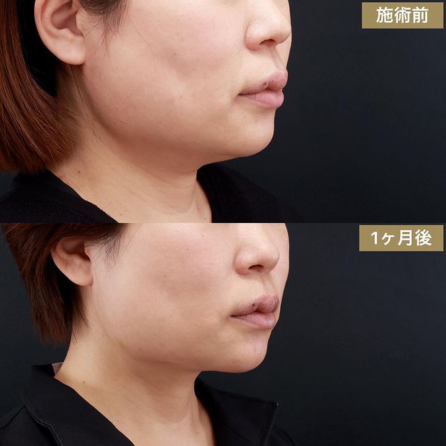 顎下の脂肪吸引の症例写真 施術前後 