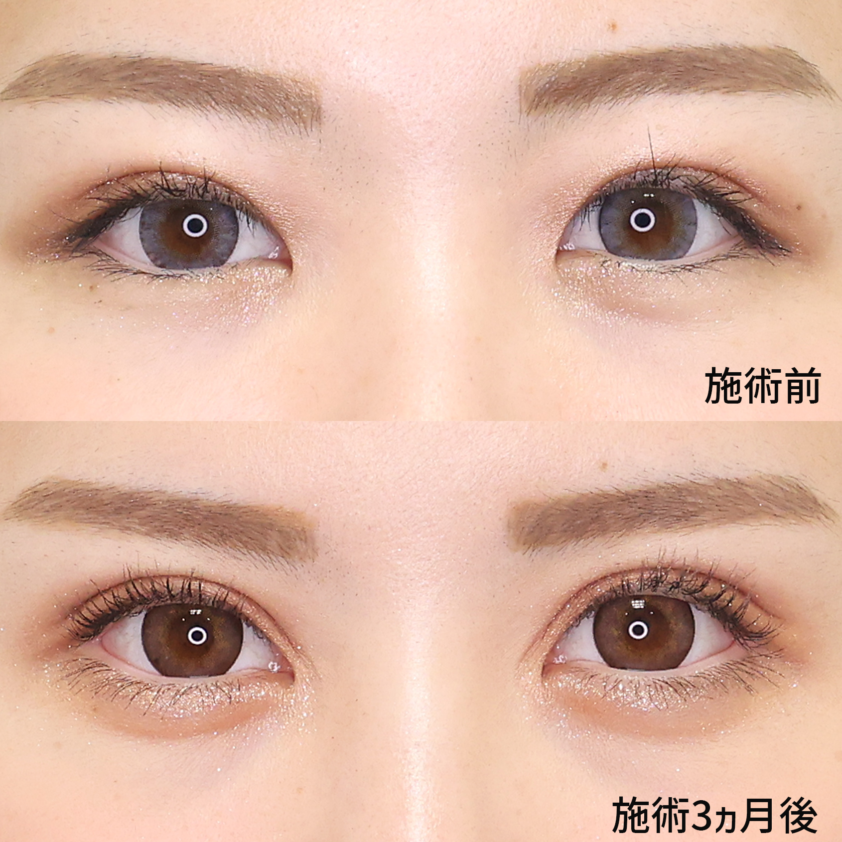 二重切開（全切開法）/目頭切開術/目尻切開術の症例写真 施術前後 
