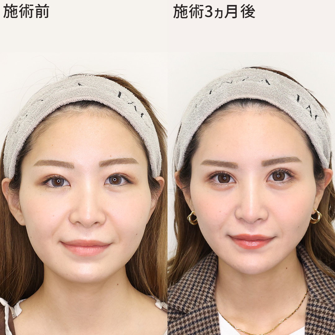 二重切開（全切開法）/目頭切開術/目尻切開術の症例写真 施術前後 