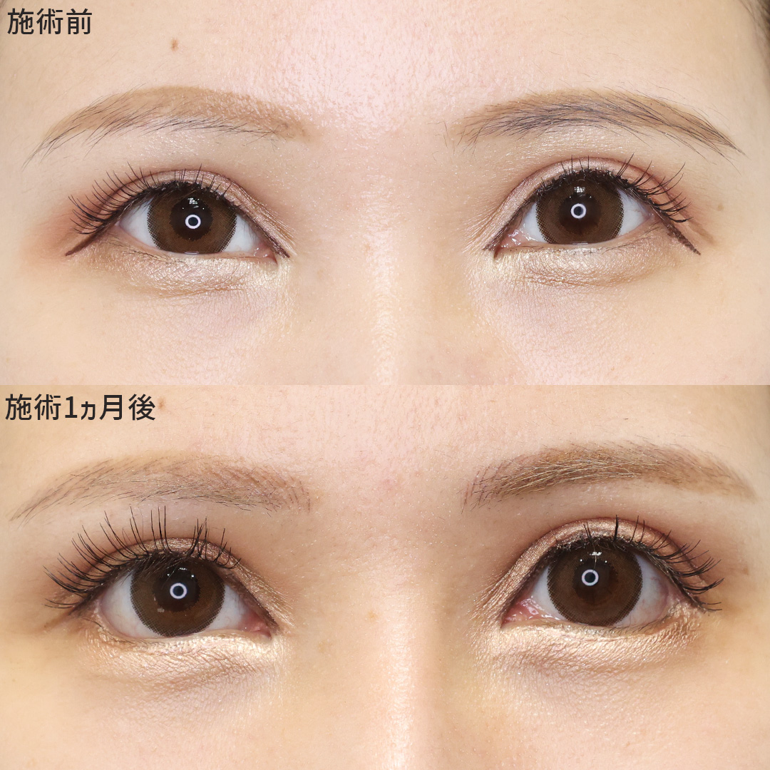 目尻靭帯移動術/下眼瞼脱脂術（目の下のたるみ取り・目の下の脂肪ふくらみ取り）/グラマラスライン（タレ目形成）の症例写真 施術前後 