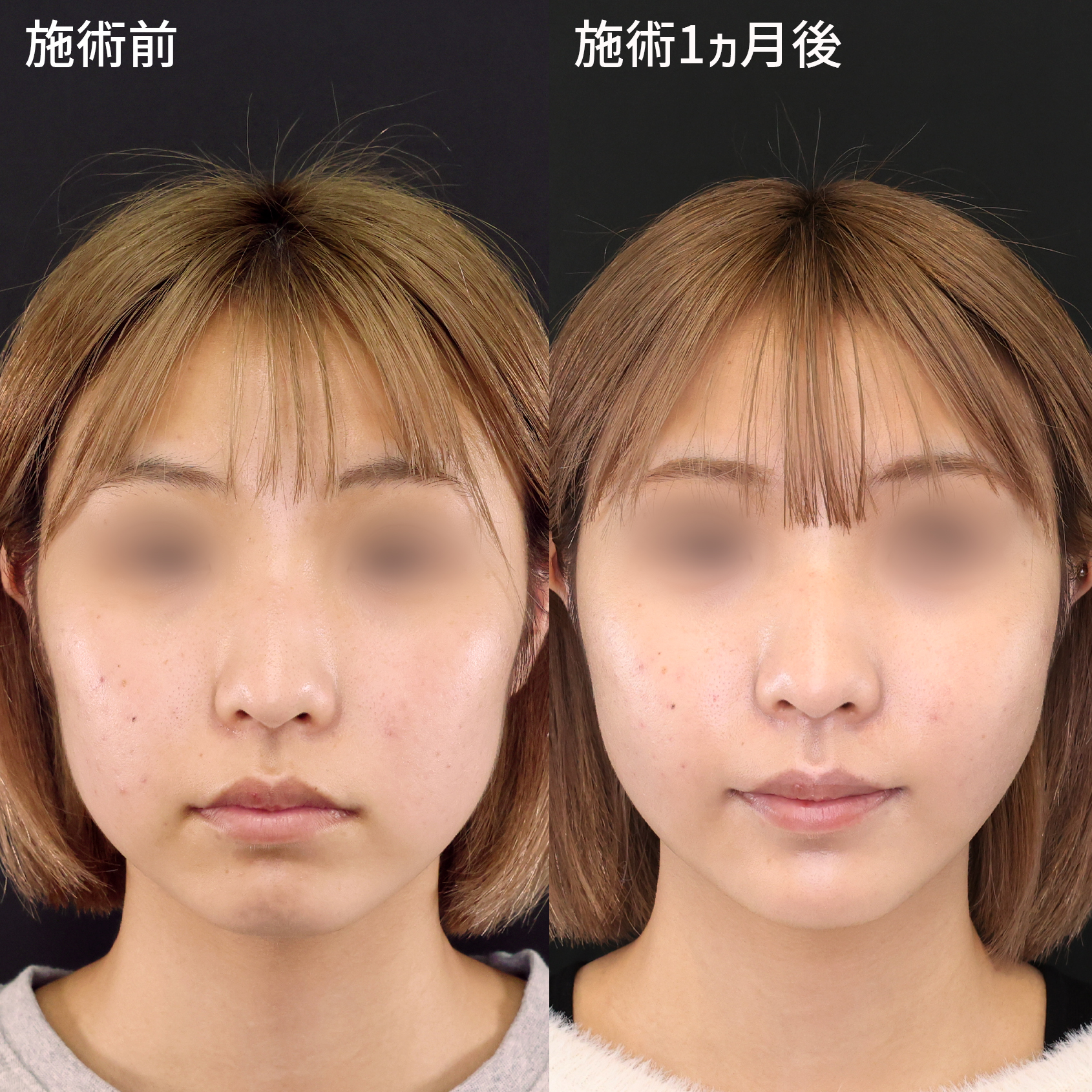 小顔整形｜パーフェクトフェイスライン/ジョールファット除去/TAC式 ツヤ肌コラーゲンリフト®の症例写真 施術前後  施術前・施術１ヵ月後