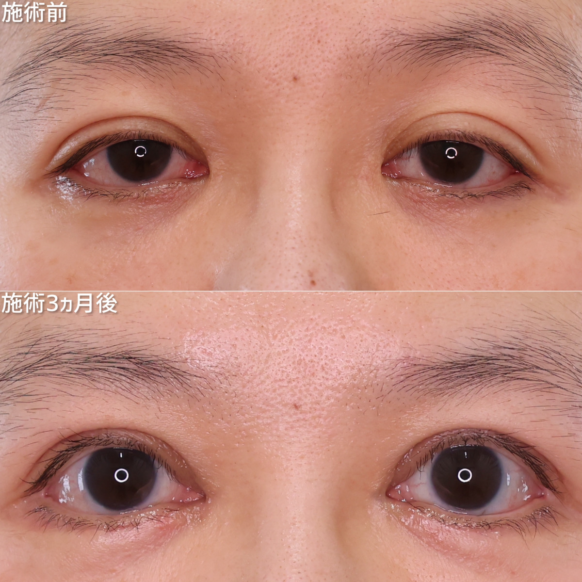40代～50代の肌のたるみの原因