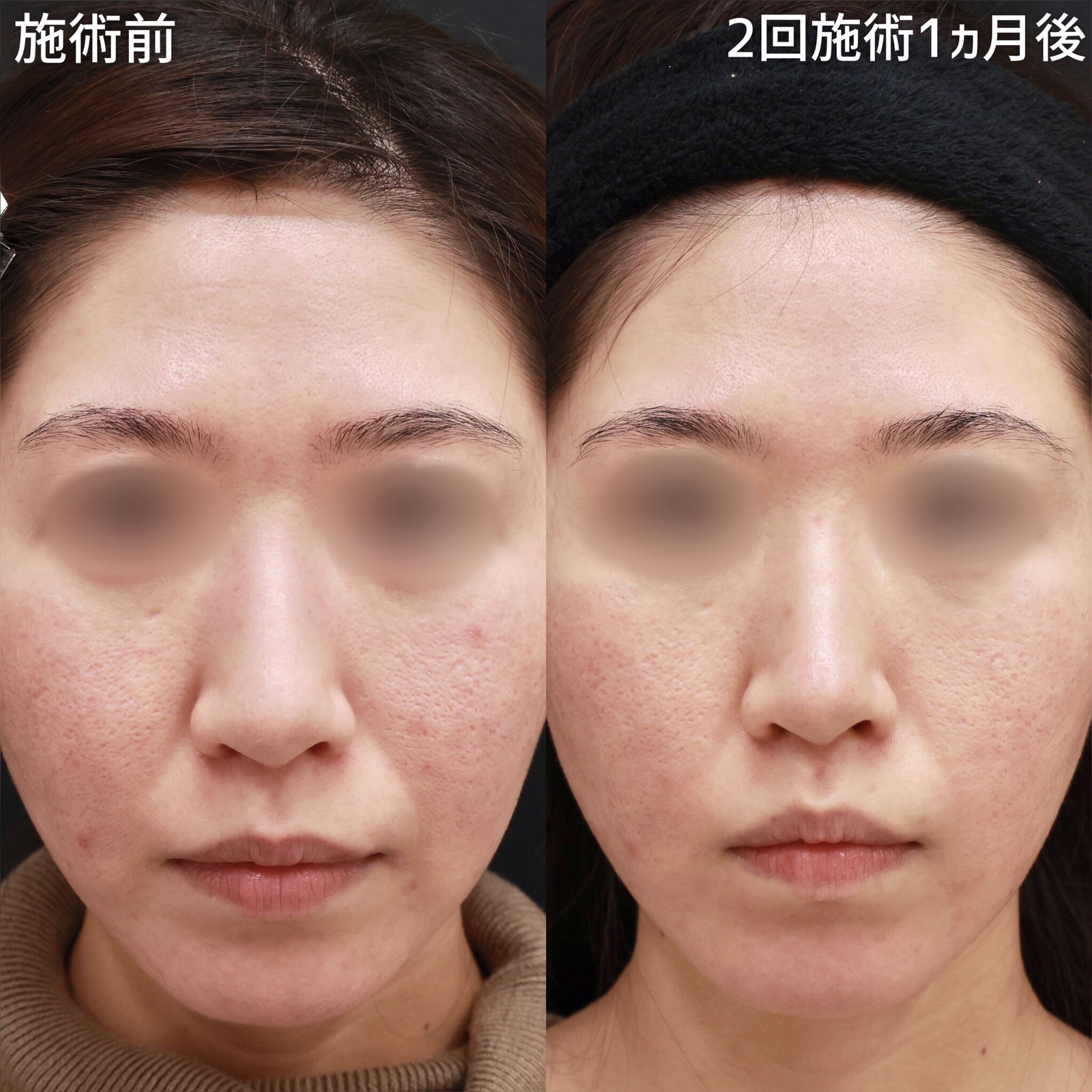 ダーマペン4/エクソソーム/ベルベットスキンの症例写真 施術前後 １ヵ月