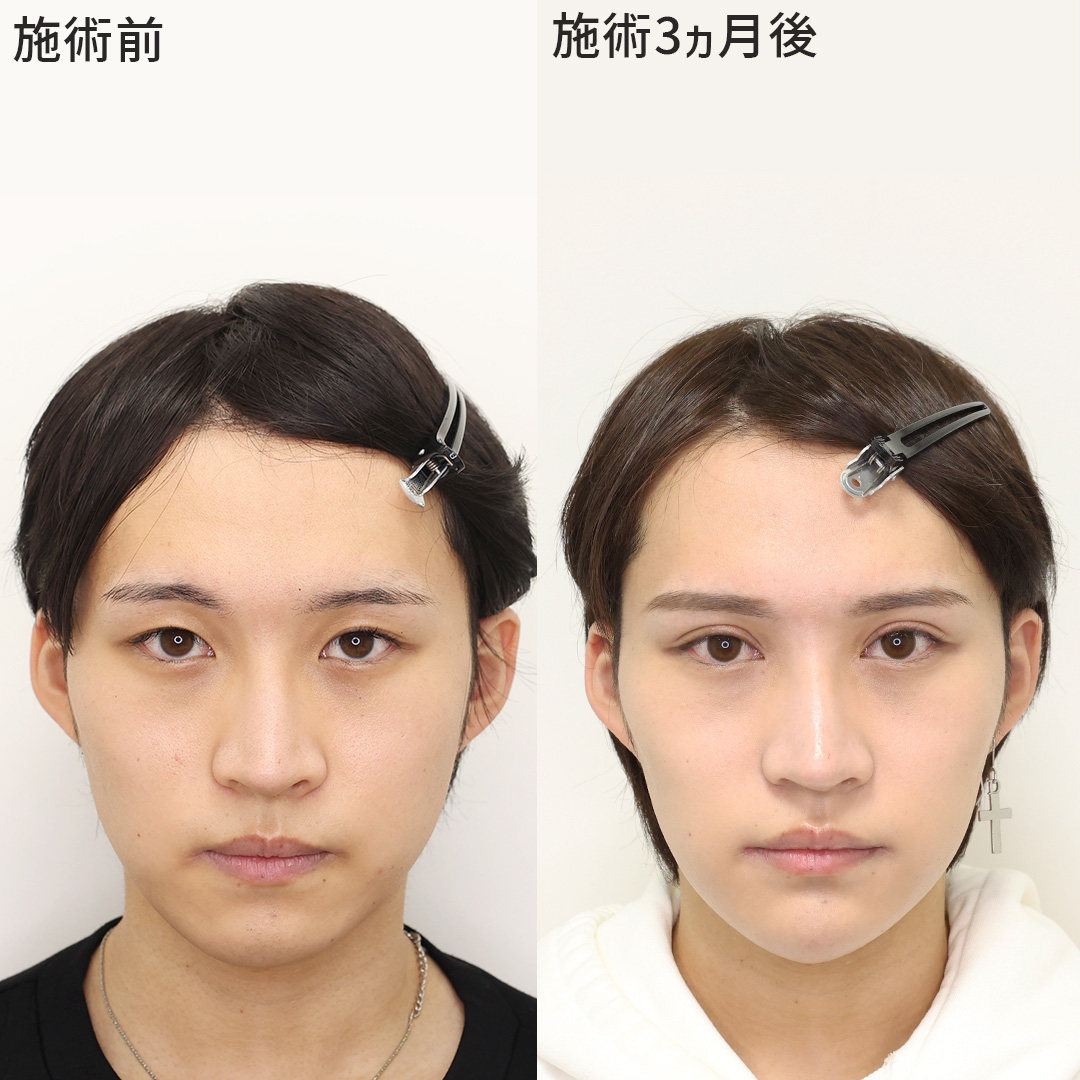 目頭切開術/二重切開（全切開法）/口角挙上・リフト（マイクロ切開法・内側法/口内法）の症例写真 施術前後 