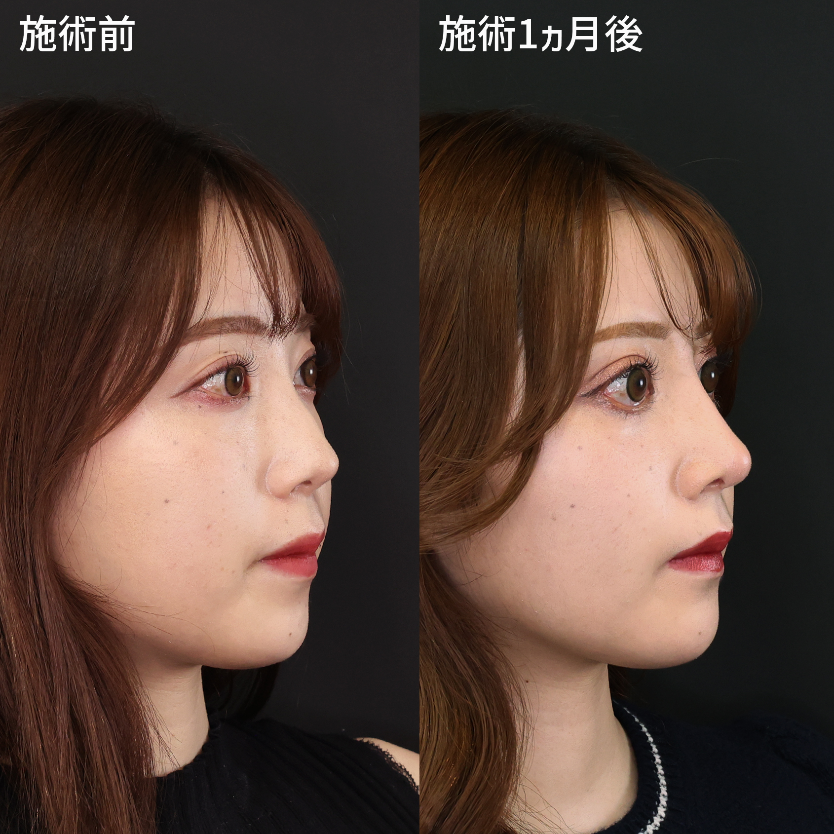 鼻中隔延長術/鼻尖形成・鼻尖縮小/隆鼻術（プロテーゼ・自家組織）の症例写真 施術前後 １ヵ月