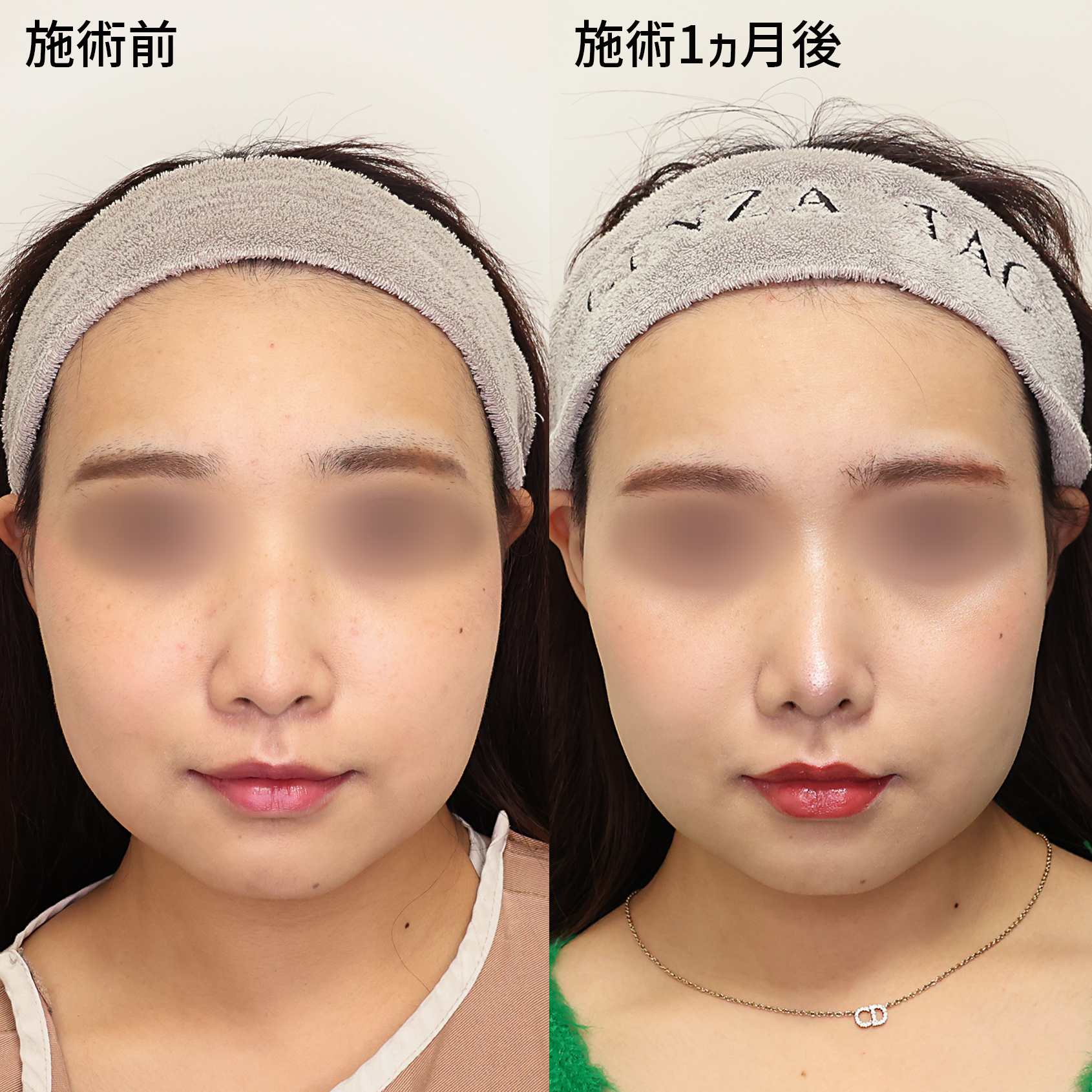 鼻中隔延長術/鼻尖形成・鼻尖縮小/鼻先軟骨移植の症例写真 施術前後 １ヵ月