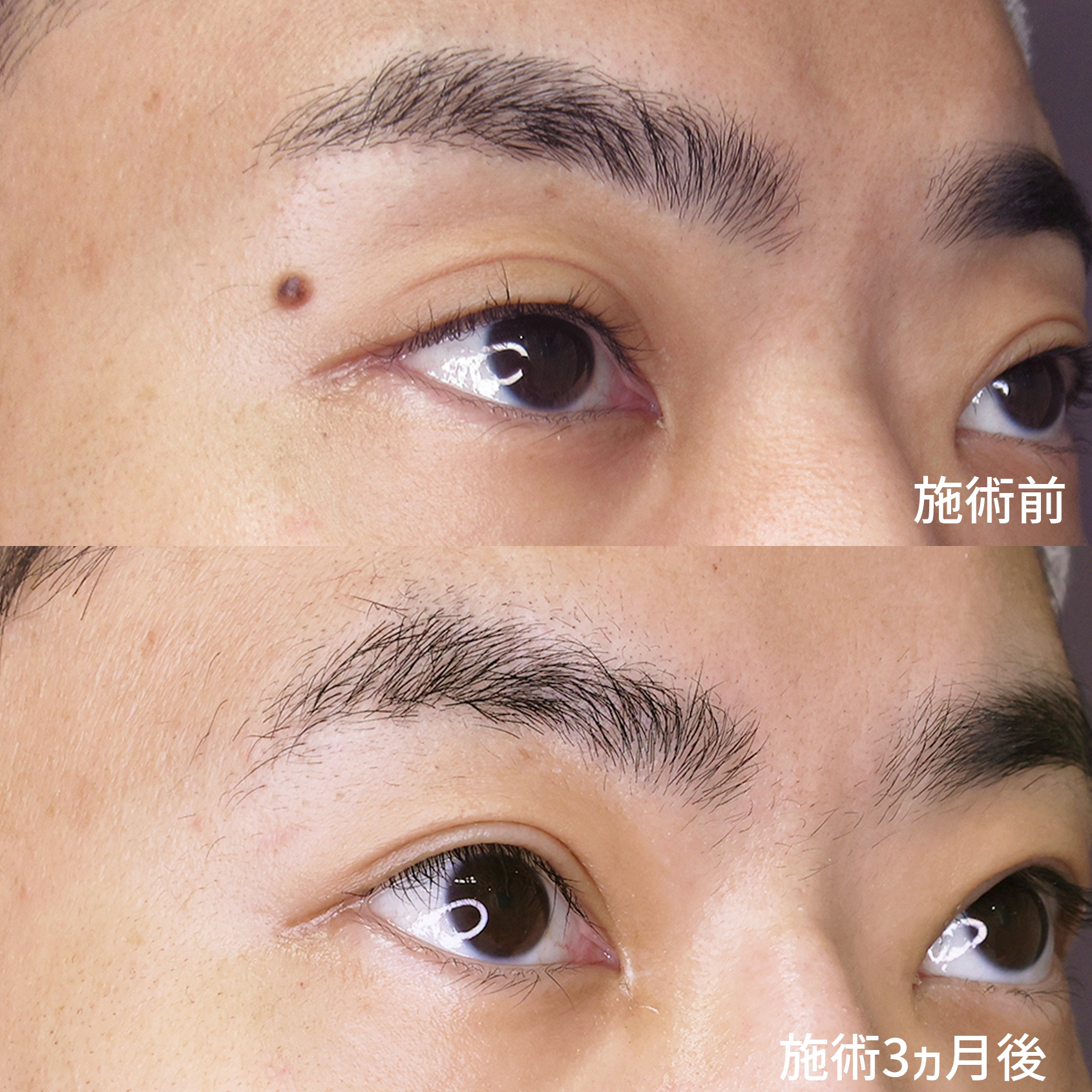 ホクロ除去の症例写真 施術前後 
