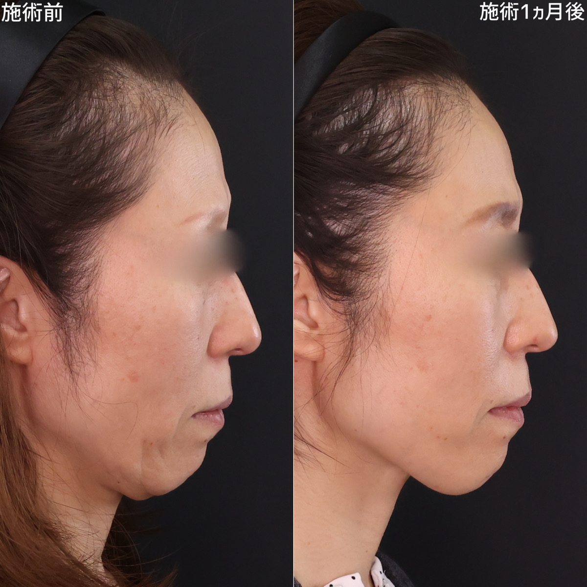 TAC式 ツヤ肌コラーゲンリフト®の症例写真 施術前後 1ヵ月
