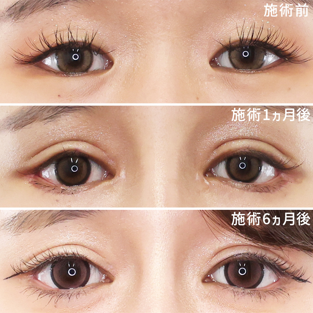 二重切開（全切開法）/目頭切開術/目尻切開術の症例写真 施術前後 