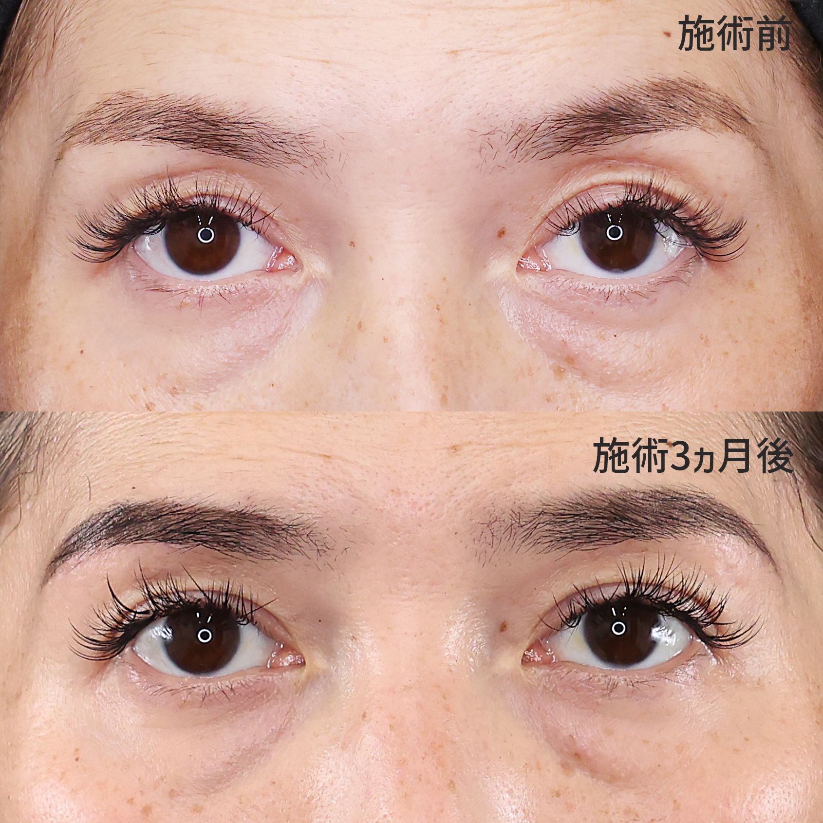 二重埋没法/片目二重術（片目だけ整形したい方）/眉毛下切開術の症例写真 施術前後 