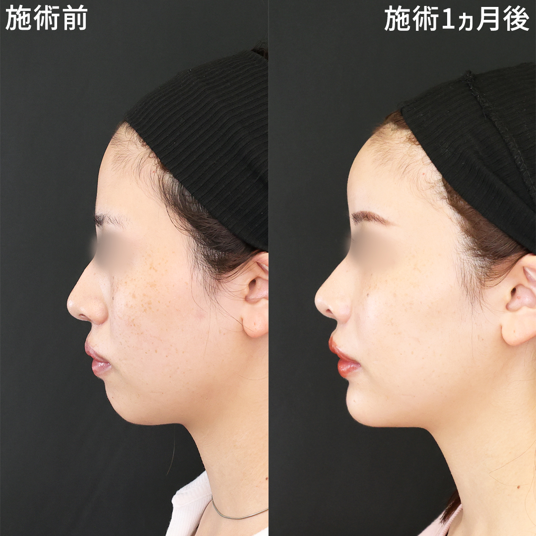 顔の脂肪注入で叶える《麗しの横顔》