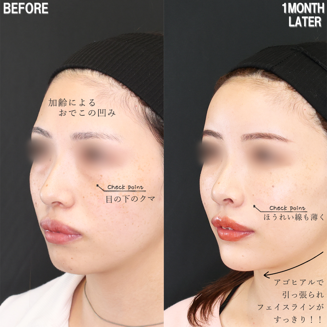 おでこの脂肪注入（オルチャンデコ形成）/顔の脂肪注入(コンデンスリッチフェイス)/下眼瞼脱脂術（目の下のたるみ取り・目の下の脂肪ふくらみ取り）の症例写真 施術前後 