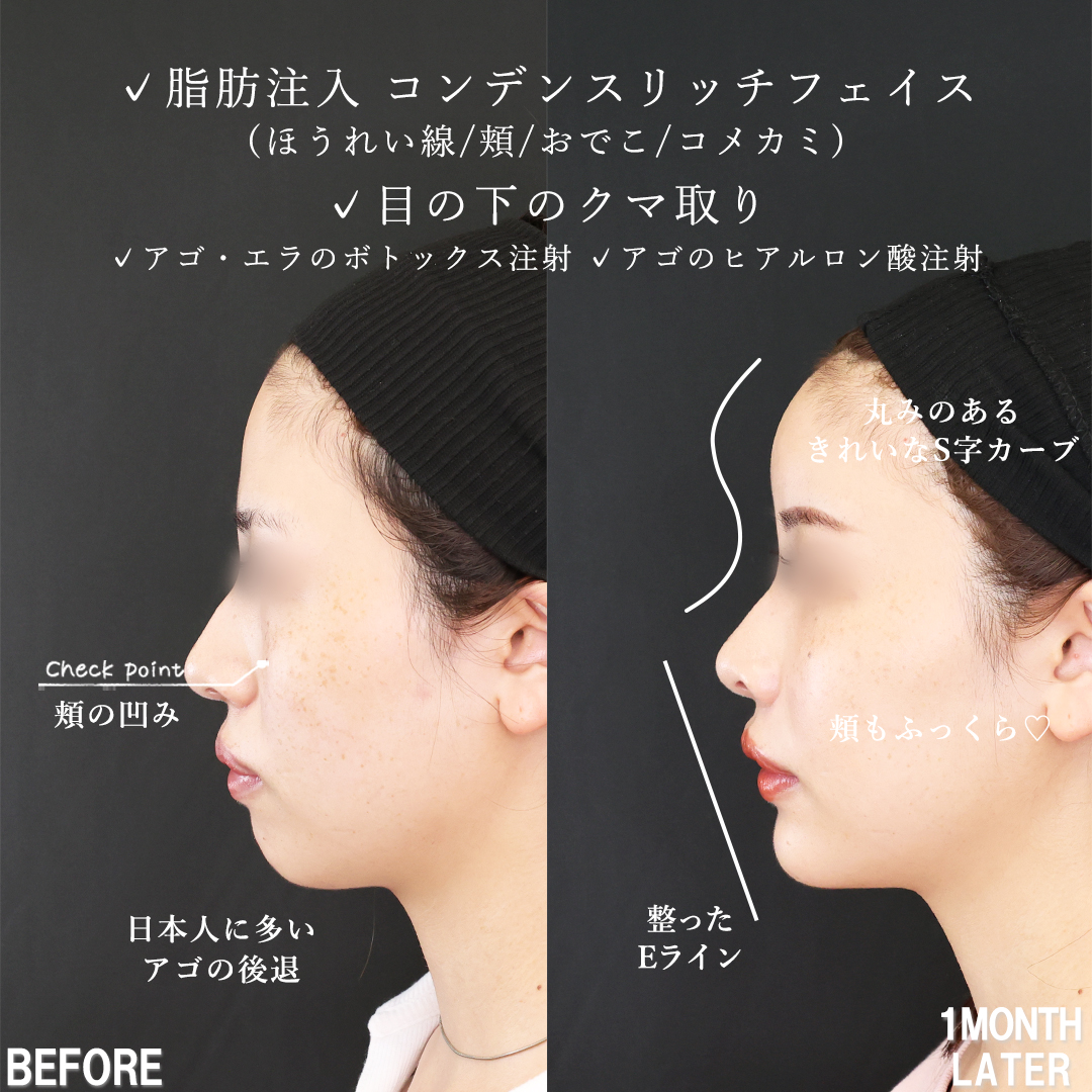 おでこの脂肪注入（オルチャンデコ形成）/顔の脂肪注入(コンデンスリッチフェイス)/下眼瞼脱脂術（目の下のたるみ取り・目の下の脂肪ふくらみ取り）の症例写真 施術前後 