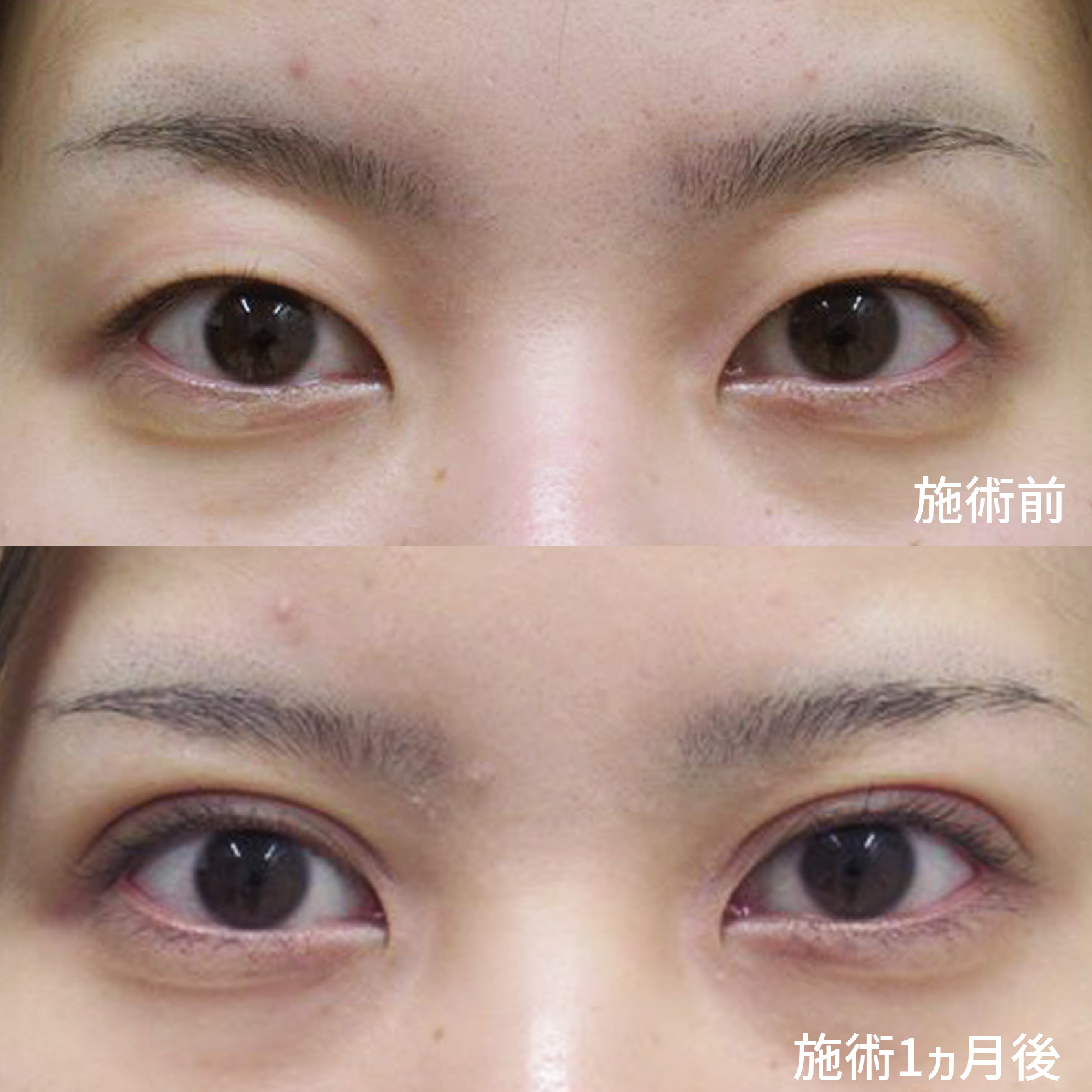 二重埋没法の症例写真 施術前後 1ヵ月