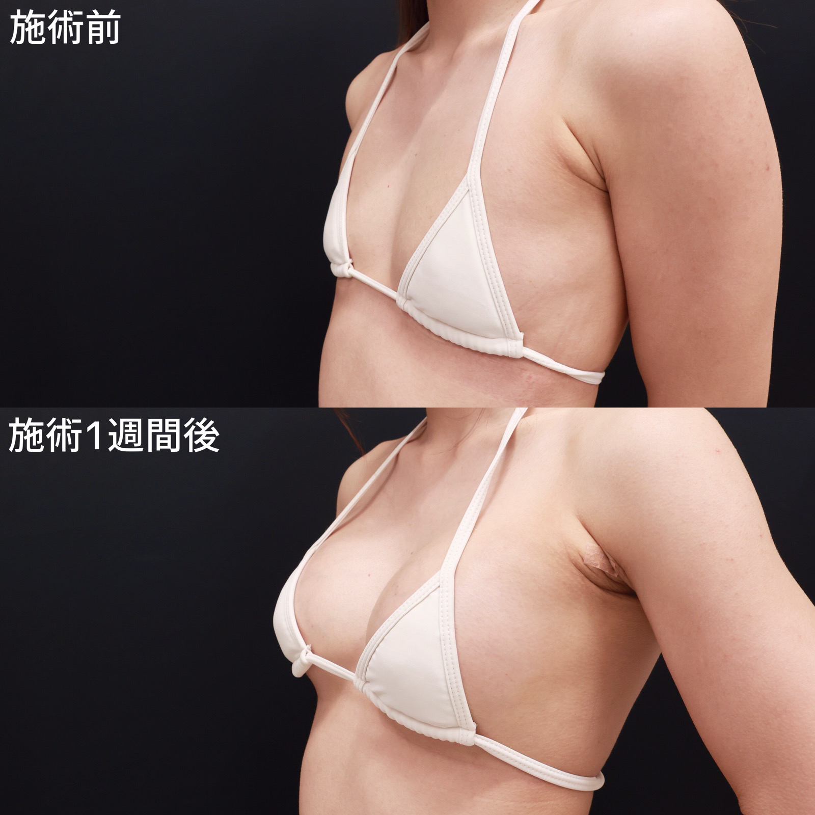 ヒアルロン酸注入豊胸術（グラビアバスト）の症例写真 施術前後 