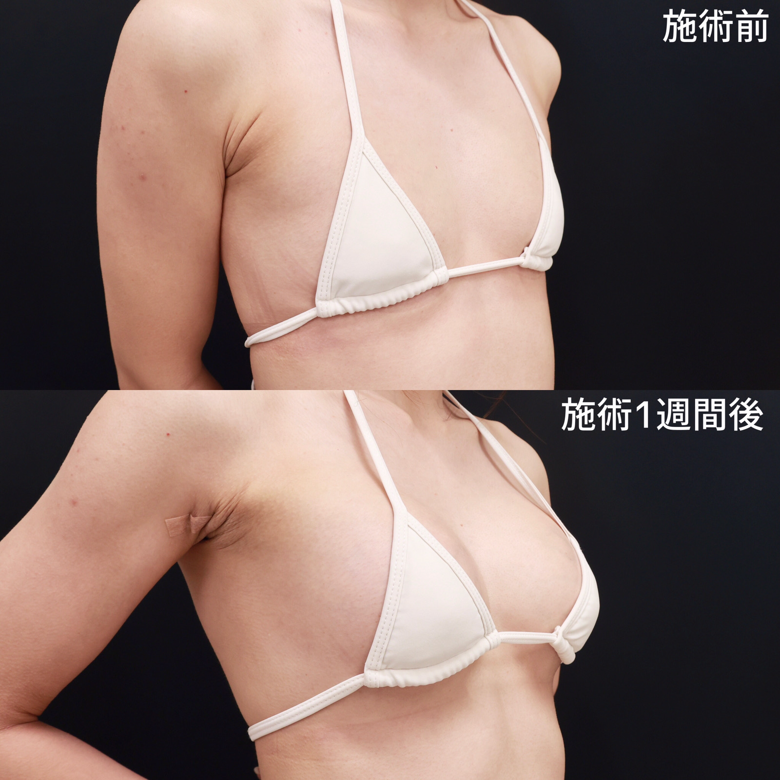 ヒアルロン酸注入豊胸術（グラビアバスト）の症例写真 施術前後 