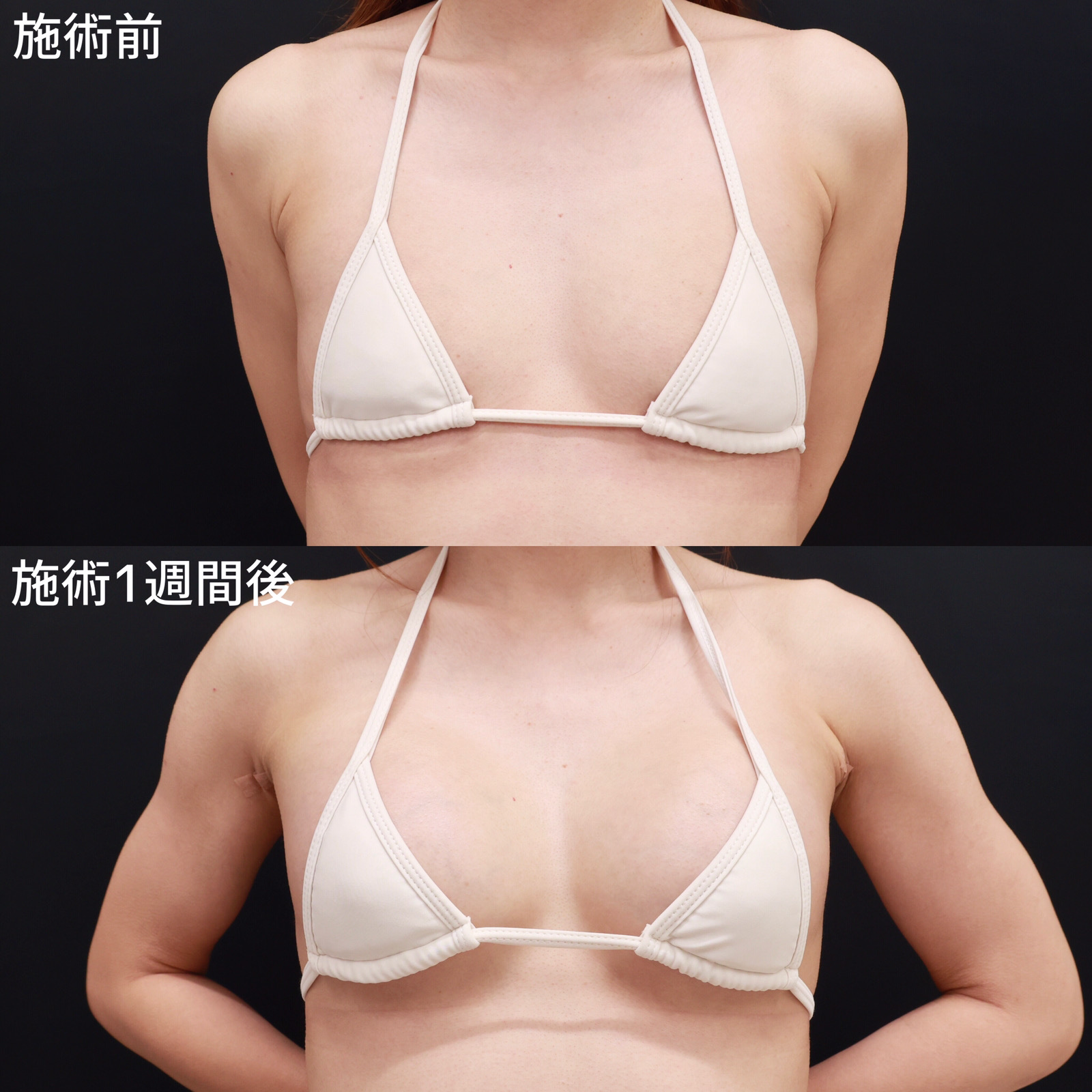 ヒアルロン酸注入豊胸術（グラビアバスト）の症例写真 施術前後 
