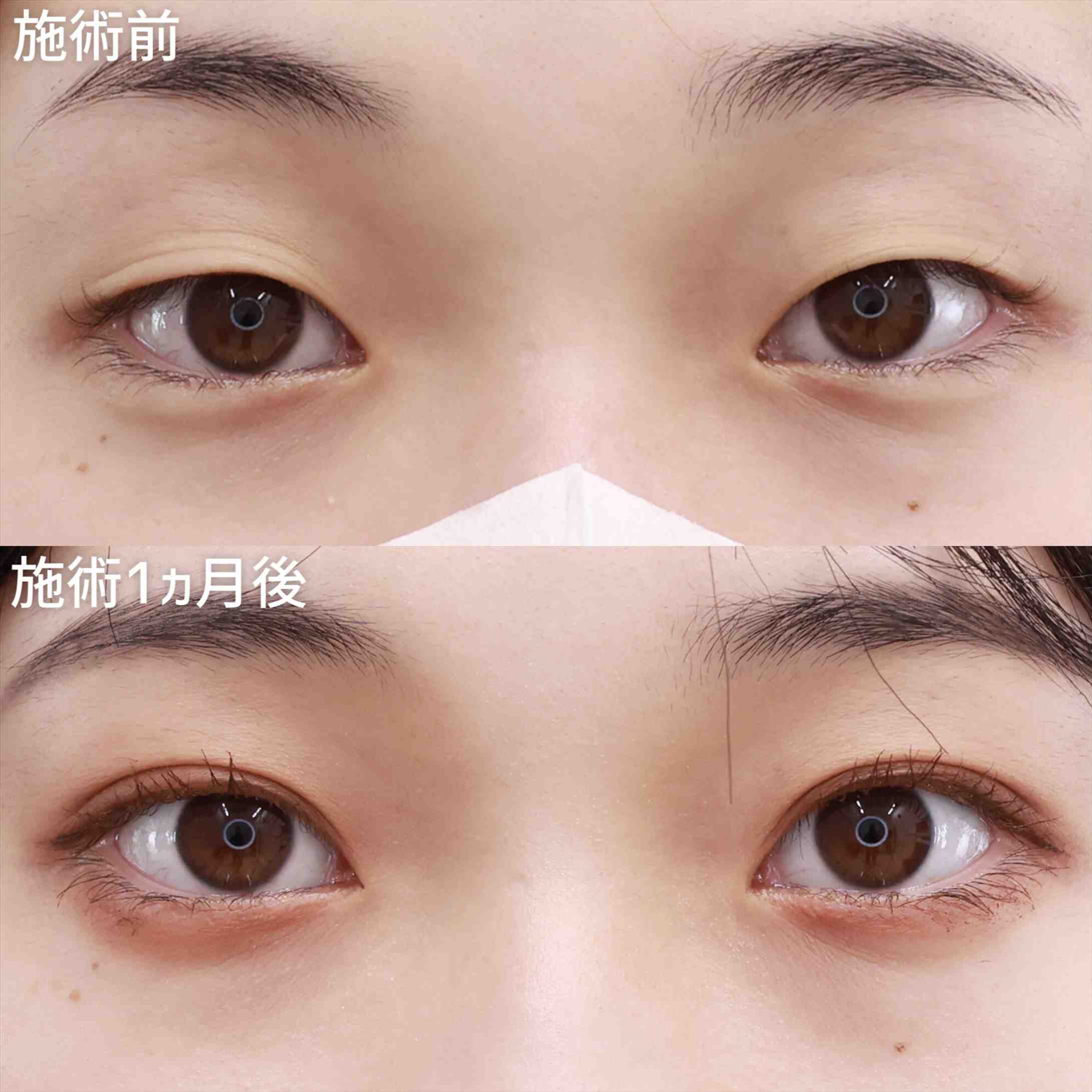 クイックコスメリングの症例写真 施術前後 
