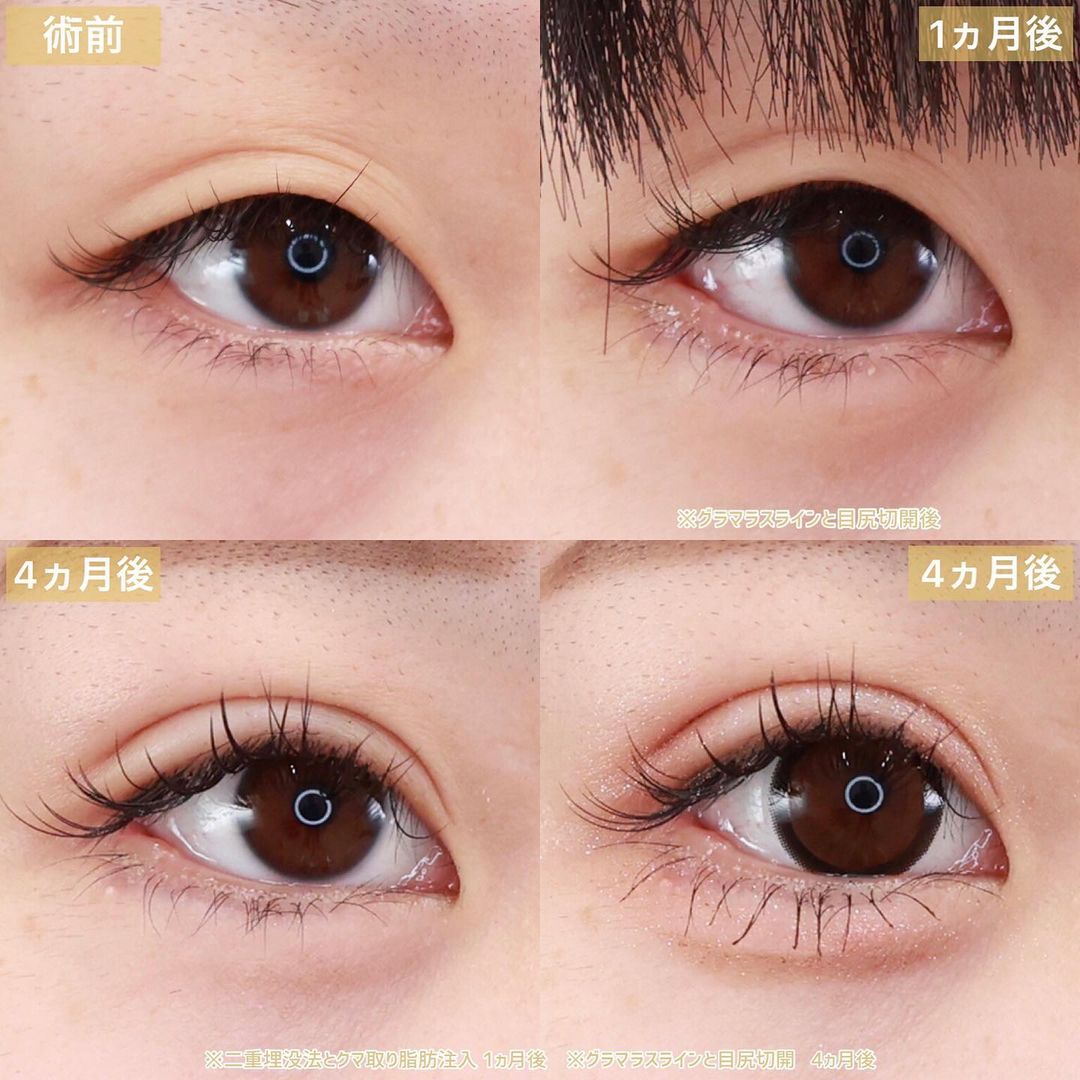 クイックコスメリング/下眼瞼脱脂術（目の下のたるみ取り・目の下の脂肪ふくらみ取り）/顔の脂肪注入(コンデンスリッチフェイス)の症例写真 施術前後 