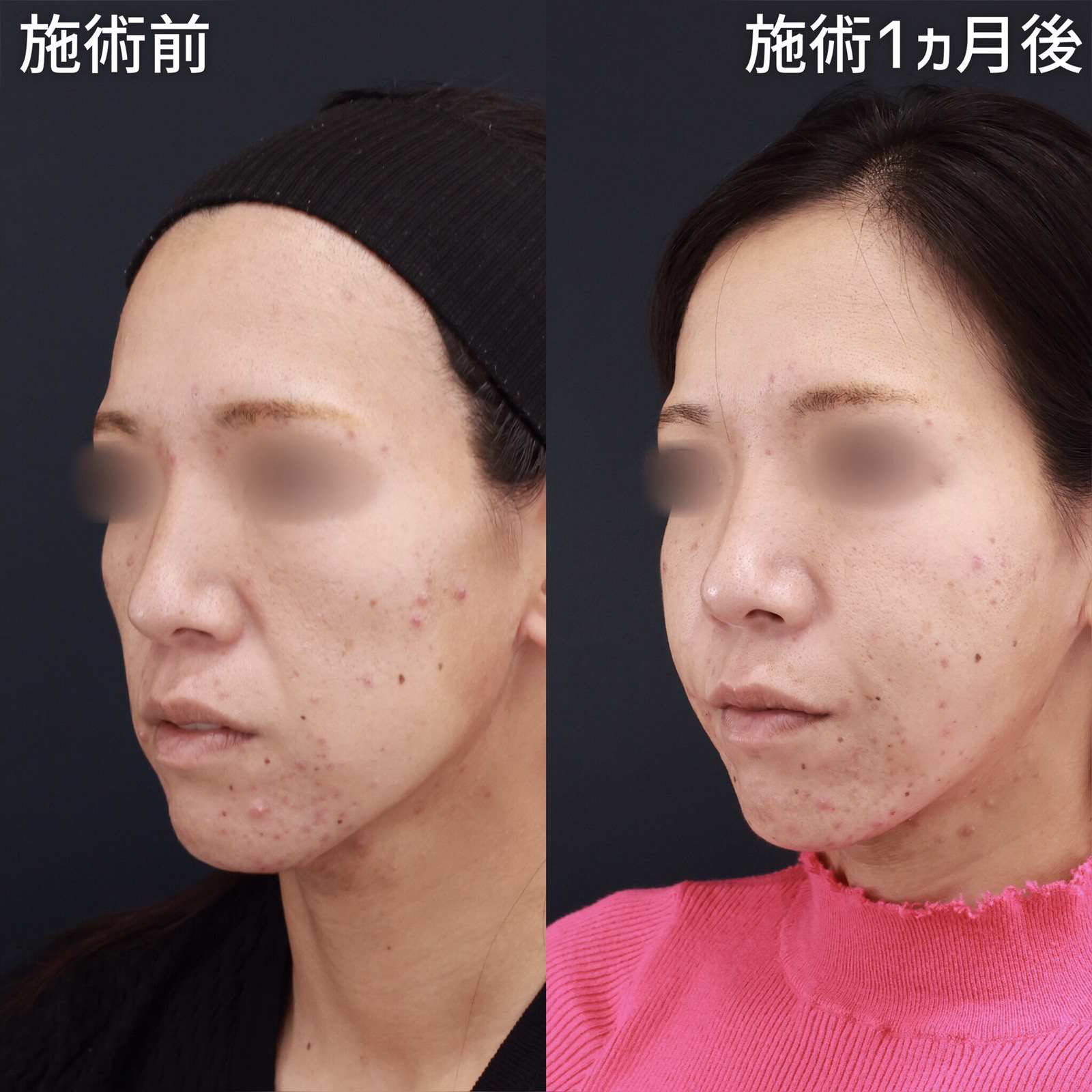 TAC式 ツヤ肌コラーゲンリフト®/エラボトックス注射/顔の脂肪注入(コンデンスリッチフェイス)の症例写真 施術前後 