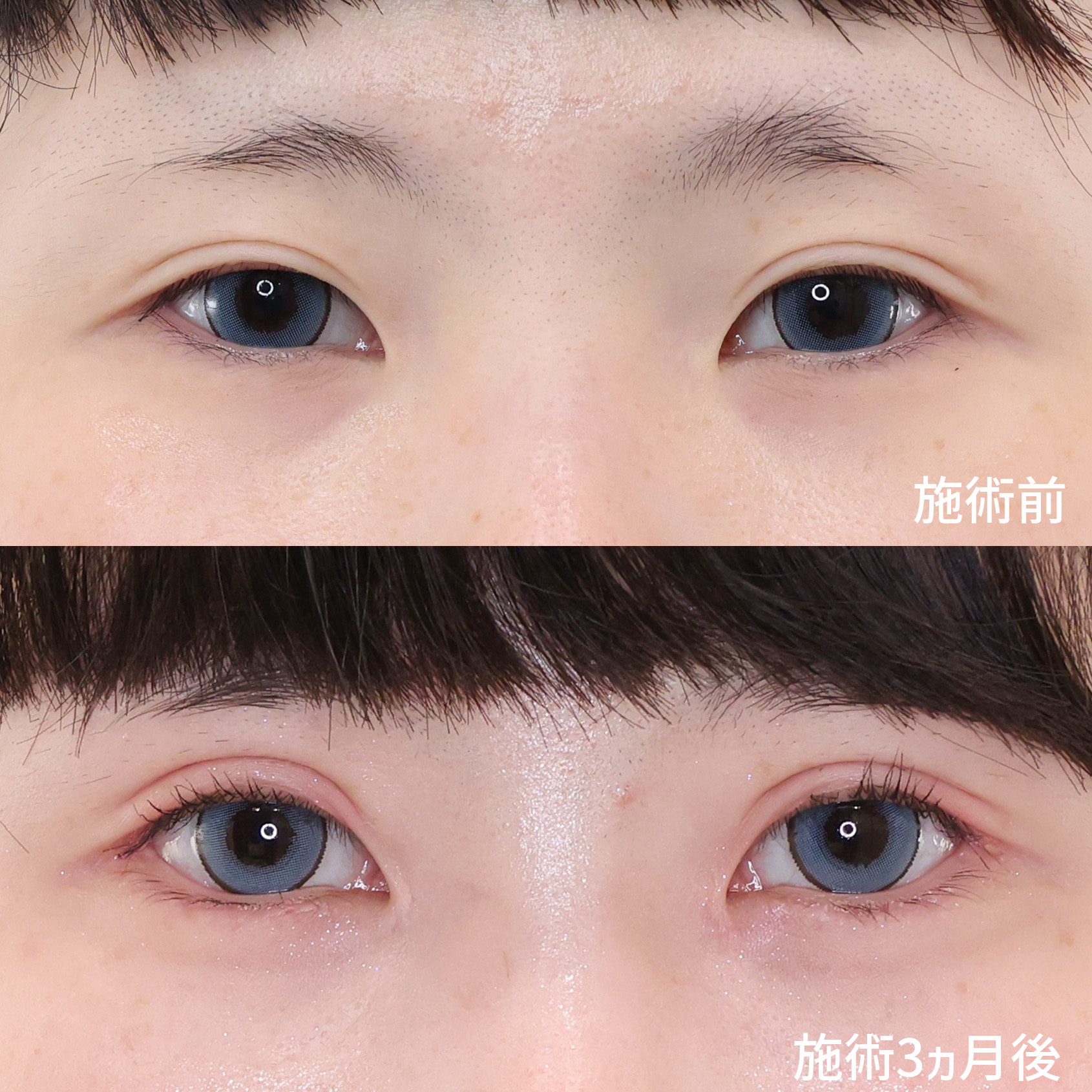 上眼瞼切開術/目頭切開術/目尻切開術の症例写真 施術前後 