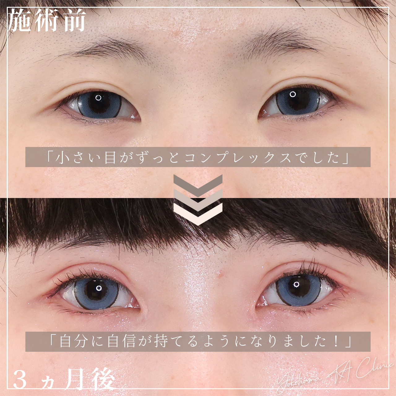 上眼瞼切開術/目頭切開術/目尻切開術の症例写真 施術前後 