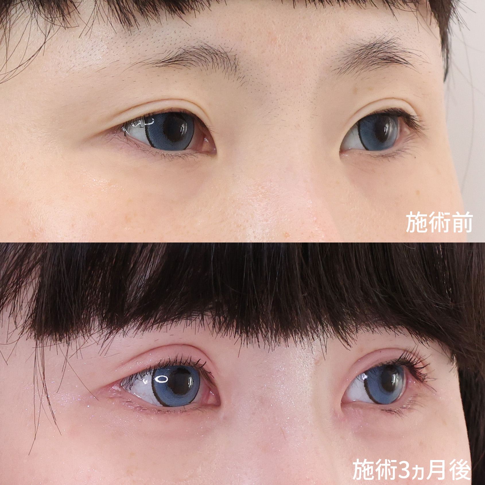 上眼瞼切開術/目頭切開術/目尻切開術の症例写真 施術前後 