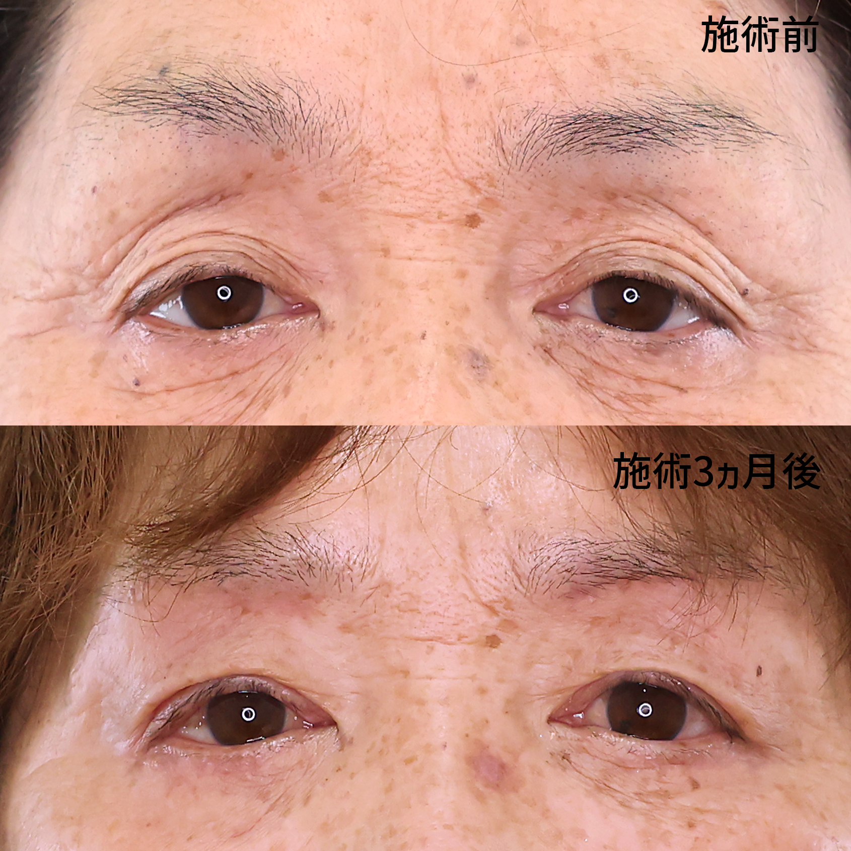 眉毛下切開術/二重切開（全切開法）/眼瞼下垂（目つき矯正）の症例写真 施術前後 